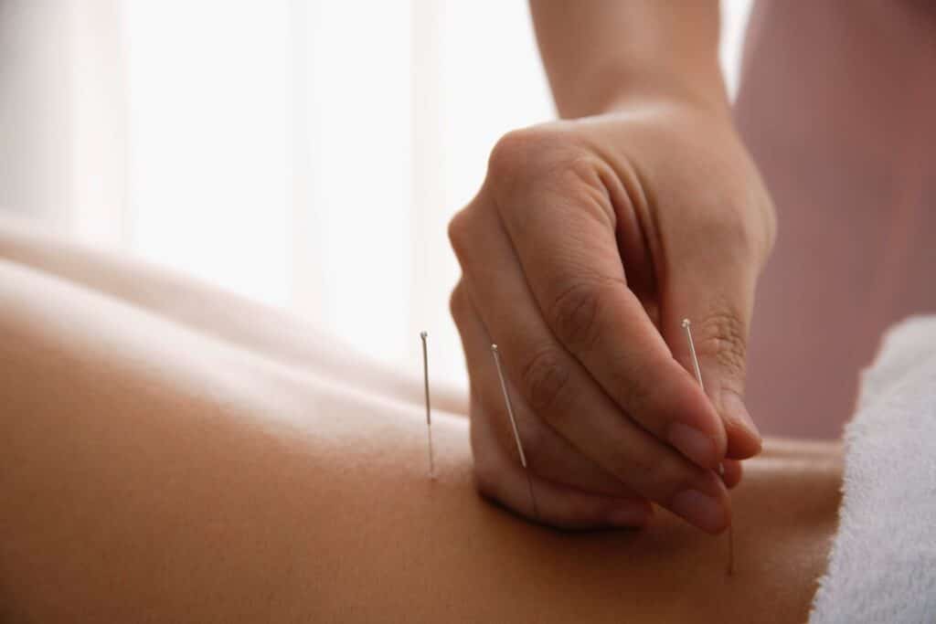 acupuncture